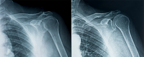 X-ray 어깨뼈 정밀검사 이미지