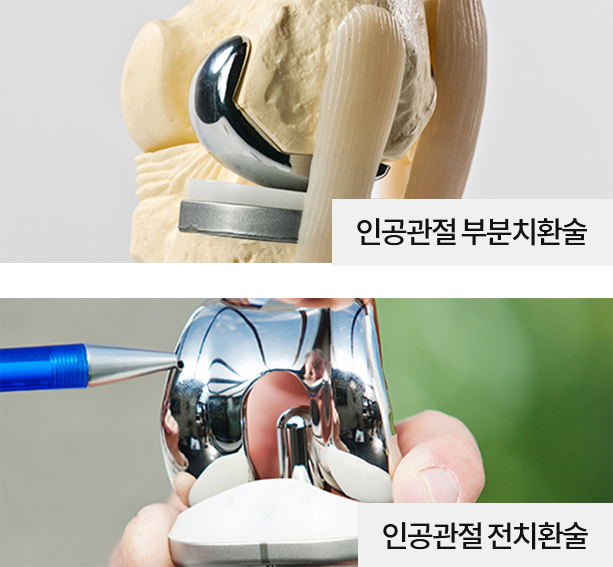 인공관절수술 (부분치환술·전치환술) 이미지